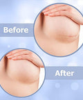 Areola Silicone Scar Sheets For Surgical Scars From Breast Reduction, Augmentation, Lift Or Post Mastectomy - 2 Pack -Reusable And Comfortable Under Post Op Bra