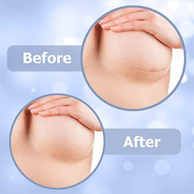 Areola Silicone Scar Sheets For Surgical Scars From Breast Reduction, Augmentation, Lift Or Post Mastectomy - 2 Pack -Reusable And Comfortable Under Post Op Bra