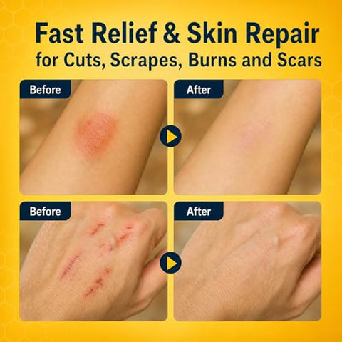 Manuka Honey for Wounds, Wound Healing Ointment for Cuts, Scrapes, Burns, Foot Ulcers and Scars, Fast Relief & Skin Repair, Non-Sticky, No Crystallization, 1.06 oz
