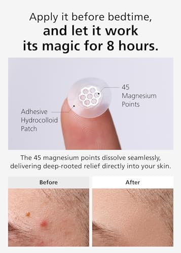 Dweasyderm Easyderm Quick Calming Magnesium Patches With Tweezers & Ampoule(10Ea)+Real Calming Microdart Pimple Patches Clear Nano Micropoint Acne Dark Spot Care(12Ea)