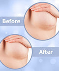 Breast Augmentation Post Surgery Supplies- Silicone Scar Sheets For Breast Surgical Scars-Breast Reduction Recovery Supplies After Surgery Needs- Comfortable Under Post Op Bra
