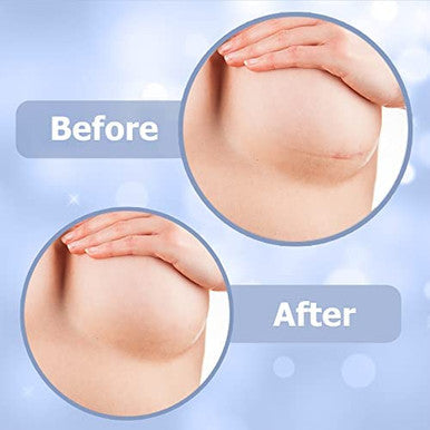 Breast Augmentation Post Surgery Supplies- Silicone Scar Sheets For Breast Surgical Scars-Breast Reduction Recovery Supplies After Surgery Needs- Comfortable Under Post Op Bra
