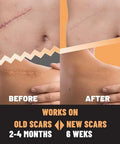 Tolevita Silicone Scar Patches Silicone Gel Sheets For Scars Acne Surgery Keloid Scar Removal And Stretch Marks Gentle Scar Care And Fading 5 Sheets