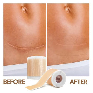 Frankos Medical Grade Silicone Scar Tape - 1.6" X 120" Roll-3M - Soft Scar Sheets For For All Scars Including C-Section, Tummy Tuck, Keloid, Acne, Burn, Injury, Surgical Scars, And More.