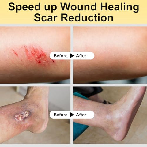 Manuka Honey for Wounds, Speed up Healing for Cuts, Surgical Wounds, Scars, Foot Ulcers, Infection, Burns, Non-Sticky, No Crystallization, Easy to Apply, 3.88 oz