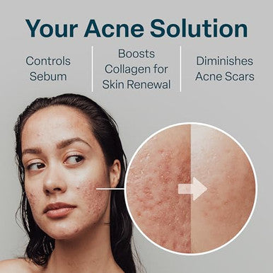 Qrxlabs Glycolic + Salicylic Acid Acne Control Pads With 10% Ultra Pure Glycolic & 2% Salicylic Allantoin Vitamin B5 C & E Calendula & Green Tea - Acne Treatment For Clear Skin