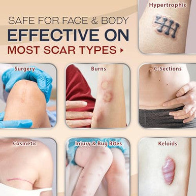 Ebanel Silicone Scar Gel With Allantoin, Emu Oil, Vitamin E And Onion Extract, For Old & Scars From Surgeries, C-Section, Injuries, Burns & More