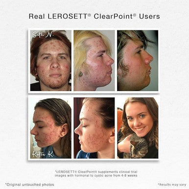 Gunilla Of Sweden Lerosett Clearpoint Anti Acne Pills, Natural Supplements For Hormonal & Cystic Acne Treatment For Oily Skin & Breakouts. 60 Caps