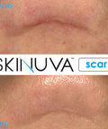 Skinuva Next Generation Scar Cream - Advanced Scar Cream Formulated With Growth Factors (1 Oz)