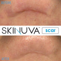 Skinuva Next Generation Scar Cream - Advanced Scar Cream Formulated With Growth Factors (1 Oz)