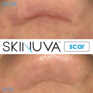 Skinuva Next Generation Scar Cream - Advanced Scar Cream Formulated With Growth Factors (1 Oz)
