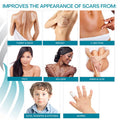 Newgel+ Advanced Silicone Scar Treatment Sheeting For Old And Scars, For Surgery, Injury, Keloids, C-Section, Burns, And Acne, Reusable, 1" X 6" Sheet (4 Count) - Clear