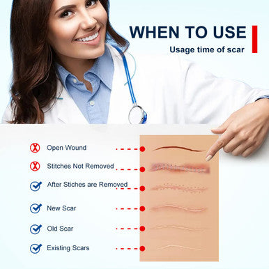 Silicone Scar Sheets, Silicone Scar Tape, Scar Sheet For Surgical Scars, C Section Scar Silicone Strips, Medical Grade, Reusable, Soften And Flattens Scars, Breast, Keloid, Professional Scar Patches.