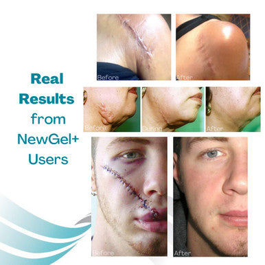 Newgel+ Advanced Silicone Professional Scar Treatment Sheeting 1 Mm Thick For Areola, Post Surgery Cosmetic Procedure, 1 Pair (2 Count) Per Box - Clear