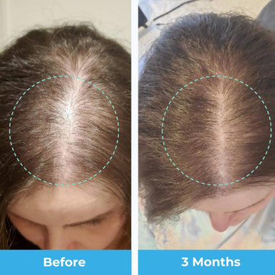 Baby Blues Postpartum Hair Loss Vitamins - Passion Fruit Gummies With Biotin, Collagen, & Folate