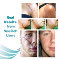 Newgel+ Advanced Silicone Professional Scar Treatment Tape For Abdomen And Extremity, Post Surgery, C-Section, Injury, Keloids, Burns, Reusable, 2" X 18" Strip - Clear