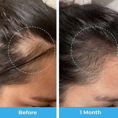 Baby Blues Postpartum Hair Loss Vitamins - Passion Fruit Gummies With Biotin, Collagen, & Folate