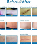 Aroamas Scar Silicone Scar Tape Softens and Flattens Scars From Surgery, Injury, Burns, C-Section, Scratch Marks Reusable Medical-Grade Silicone Scar Sheets For All Skin Types 3"X1.57", 8 Sheets