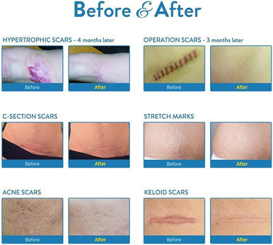 Aroamas Scar Silicone Scar Tape Softens and Flattens Scars From Surgery, Injury, Burns, C-Section, Scratch Marks Reusable Medical-Grade Silicone Scar Sheets For All Skin Types 3"X1.57", 8 Sheets