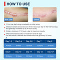 Silicone Scar Sheets, Silicone Scar Tape, Scar Sheet For Surgical Scars, C Section Scar Silicone Strips, Medical Grade, Reusable, Soften And Flattens Scars, Breast, Keloid, Professional Scar Patches.
