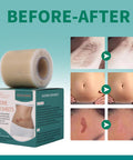 Silicone Scar Tape 1.6"X 60" Reusable Silicone Sheet For Scar Away Treatment Stretch Mark Removal Tattoo Cover Up Painless Scar Removal For Surgery, C Section, Acne, Keloid