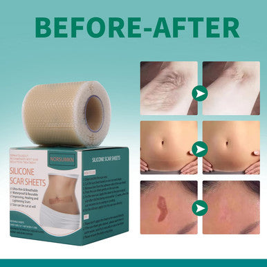 Silicone Scar Tape 1.6"X 60" Reusable Silicone Sheet For Scar Away Treatment Stretch Mark Removal Tattoo Cover Up Painless Scar Removal For Surgery, C Section, Acne, Keloid