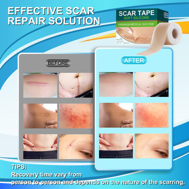 Medical Grade Silicone Scar Tape For Surgical Scars (1.6" X 157" - 4M) Professional Silicone Scar Sheets Scar Treatment For Face Wrinkles, C Section Recovery, Keloid Bump Removal Silicone Scar Patches