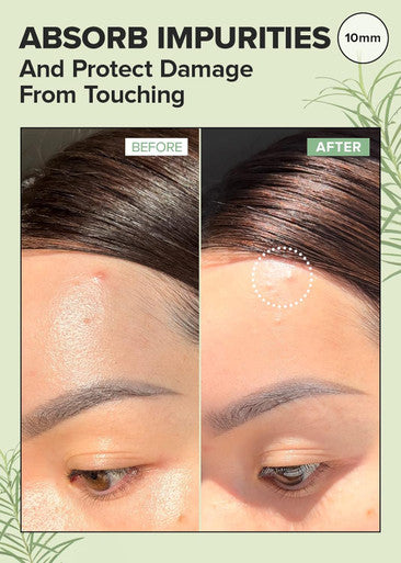 I Dew Care Hydrocolloid Acne Pimple Patch - Timeout Blemish Original + Face Cream - Say You Dew | Vitamin C Moisturizer With Niacinamide, Non-Irritating, Hydrate And Illuminate Skin Bundle