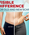 Medical Grade Silicone Scar Tape - 1.6 X150 - Visible Difference On Surgical & Keloid Scars - Reusable Silicone Scar Sheets - Easy To Use Silicone Tape For Scars