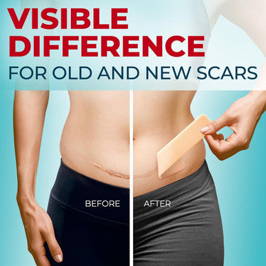Medical Grade Silicone Scar Tape - 1.6 X150 - Visible Difference On Surgical & Keloid Scars - Reusable Silicone Scar Sheets - Easy To Use Silicone Tape For Scars