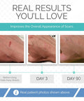 Fade Away Scars - The Original Silicone Scar Sheeting Roll- Custom Size Medical Grade- Effective Silicone Scar Sheets, Strips And Patches For Scars, Surgical Scar Tape, Scar Away Silicone Scar Sheets.