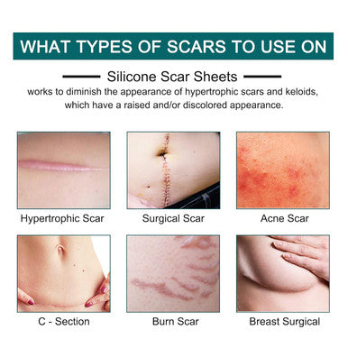 Silicone Scar Sheets (1.6 X 120 Roll-3M), Silicone Scar Tape Roll, Scar Silicone Strips, Reusable, Professional Scar Removal Sheets For C-Section, Surgery, Burn, Keloid, Acne Et