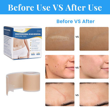 Silicone Scar Sheets, Silicone Scar Tape Roll (60 X1.6 ), Professional Scars Removal Treatment, Scar Silicone Strips, Reusable Silicone Scar Strips Type For Keloid, C-Section, Surgery, Keloid, Acne