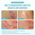 Scar Gel Advanced Scar Treatment, Silicone Scar Gel Scar Removal Scar Cream Gel Silicone Gel Scar Gel For Face C-Section Tummy Tuck Keloid And Surgical Scars Burns Old Scars Deep Acne Scar Removal