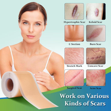 Silicone Scar Sheets, Medical Grade Silicone Scar Tape, Reusable Scar Removal Strips For Surgical Scars, C-Section, Keloid, Tummy Tuck, Burn, Acne, Surgery Scars Treatment