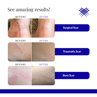 Rejuvaskin Rejuvasil Silicone Scar Gel, Scar Treatment For Surgical Scars, Burns, Keloids, Acne Scars On Face & Body, 30Ml