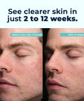 Vitamedica Clear Skin Vitamin Formula Acne Supplement For Skin Clearing Breakout Treatment For Women And Men Vitamins A, C, E, Selenium, Chromium, And Zinc For Acne And Skin Health 60 Count