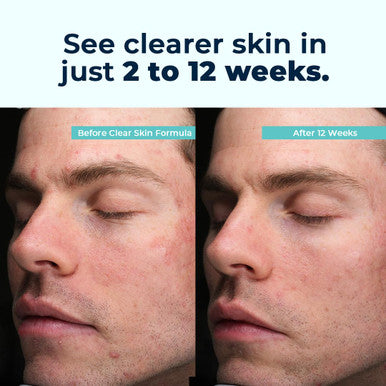 Vitamedica Clear Skin Vitamin Formula Acne Supplement For Skin Clearing Breakout Treatment For Women And Men Vitamins A, C, E, Selenium, Chromium, And Zinc For Acne And Skin Health 60 Count