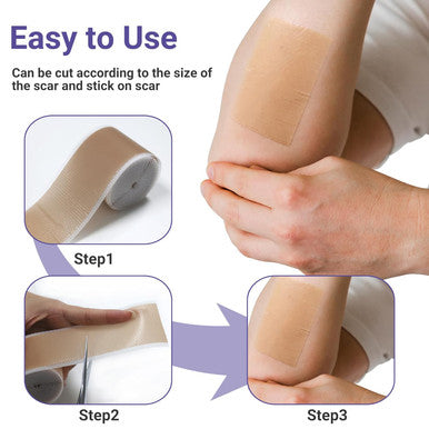 Conkote Silicone Scar Tapes (1.6 X120" Roll-3M), Medical Grade Silicone Scar Sheets, Keloid Bump Removal, Scar Tape For C-Section, Cosmetic Surgical Scars, Stretch Marks, Burn, Acne And Tummy Tuck