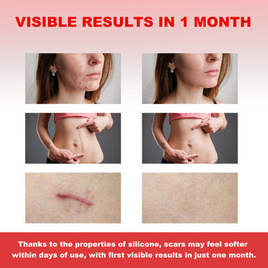 Silicone Scar Sheets - 5.9"X2.4" Extra-Large For Enhanced Coverage, Pack Of 8 - Comfortable, Effective For Acne, Post-Surgery Scars, Hypertrophic, Keloid, Tummy Tucks