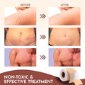 Silicone Scar Sheets For Surgical Scars: Silicone Scar Tape For C Section, Tummy Tuck Tape, Keloid Treatment - Silicone Scar Strips After Surgery (1.6" X 120" Roll-3M)
