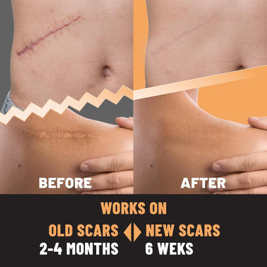 Silicone Scar Patches Silicone Gel Sheets For Scars, Acne, Surgery, Keloid, Scar Removal And Stretch Marks Gentle Scar Care & Fading - 5 Sheets