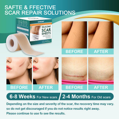 Medical Grade Silicone Scar Sheets, Silicone Scar Tape (1.6 X 120 ), Professional Scar Removal Treatment, Reusable Silicone Scar Strip For Keloid, C-Section, Surgery, Burns, Acne Etc