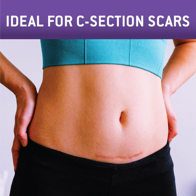 Care Science C Section Recovery Silicone Scar Sheets 1.5In X 7In 8Ct Reuseable Scar Sheets For Reducing The Appearance Of C-Section, Keloid, And Acne Scars