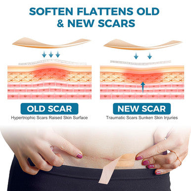Scar Away Silicone Scar Sheets, Silicone Scar Tape (1.6 X 120 Roll), Scar Removal Sheets, Scar Strips For Surgical Scars, Stretch Marks, C-Section, Keloid, Tummy Tuck, Burn, Old/Scars, Reusable