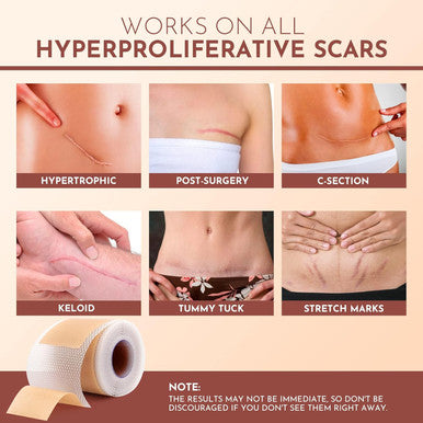 Silicone Scar Sheets For Surgical Scars: Silicone Scar Tape For C Section, Tummy Tuck Tape, Keloid Treatment - Silicone Scar Strips After Surgery (1.6" X 120" Roll-3M)