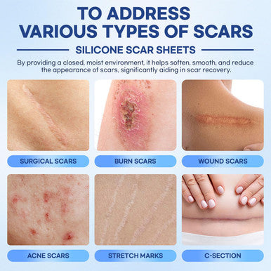 Aroamas Scar Silicone Scar Sheets Silicone Scar Tape 1.6"X60" For Softening And Flattening Scars, C-Section, Keloid, Surgery Reusable & Washable Painless Removal 3-4 Month Supply