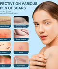 Advanced Scar Cream, Silicone Scar Gel, Treats Old And Scars, Reduces The Appearance Of Scars From, Body, Face, Stretch Marks, Surgical Scar, Keloids, Acne, Burns And More, 1.7 Oz