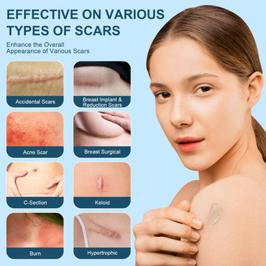 Advanced Scar Cream, Silicone Scar Gel, Treats Old And Scars, Reduces The Appearance Of Scars From, Body, Face, Stretch Marks, Surgical Scar, Keloids, Acne, Burns And More, 1.7 Oz