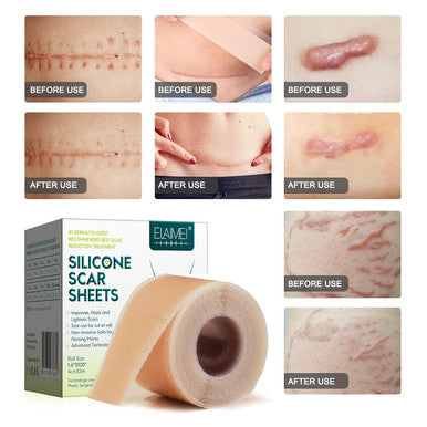 Silicone Scar Sheets (1.6 X 120 Roll-3M), Silicone Scar Tape Roll, Scar Silicone Strips, Reusable, Professional Scar Removal Sheets For C-Section, Surgery, Burn, Keloid, Acne Et